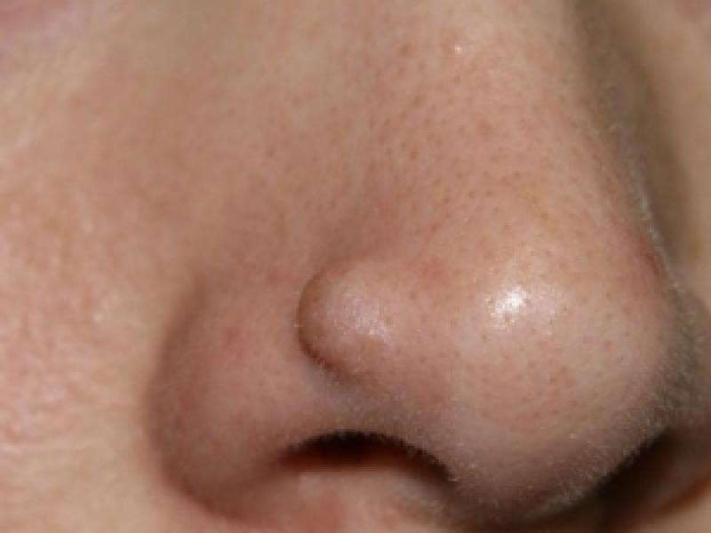 Жировики на лице: причины появления и способы лечения